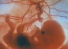 A foetus